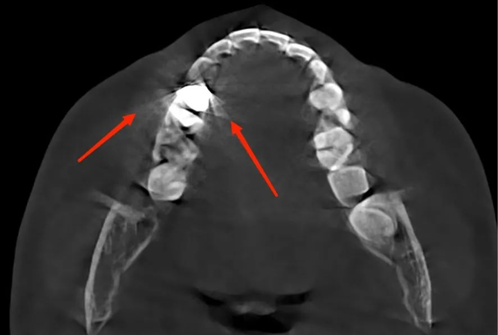 Motion artifacts in a CBCT scan
